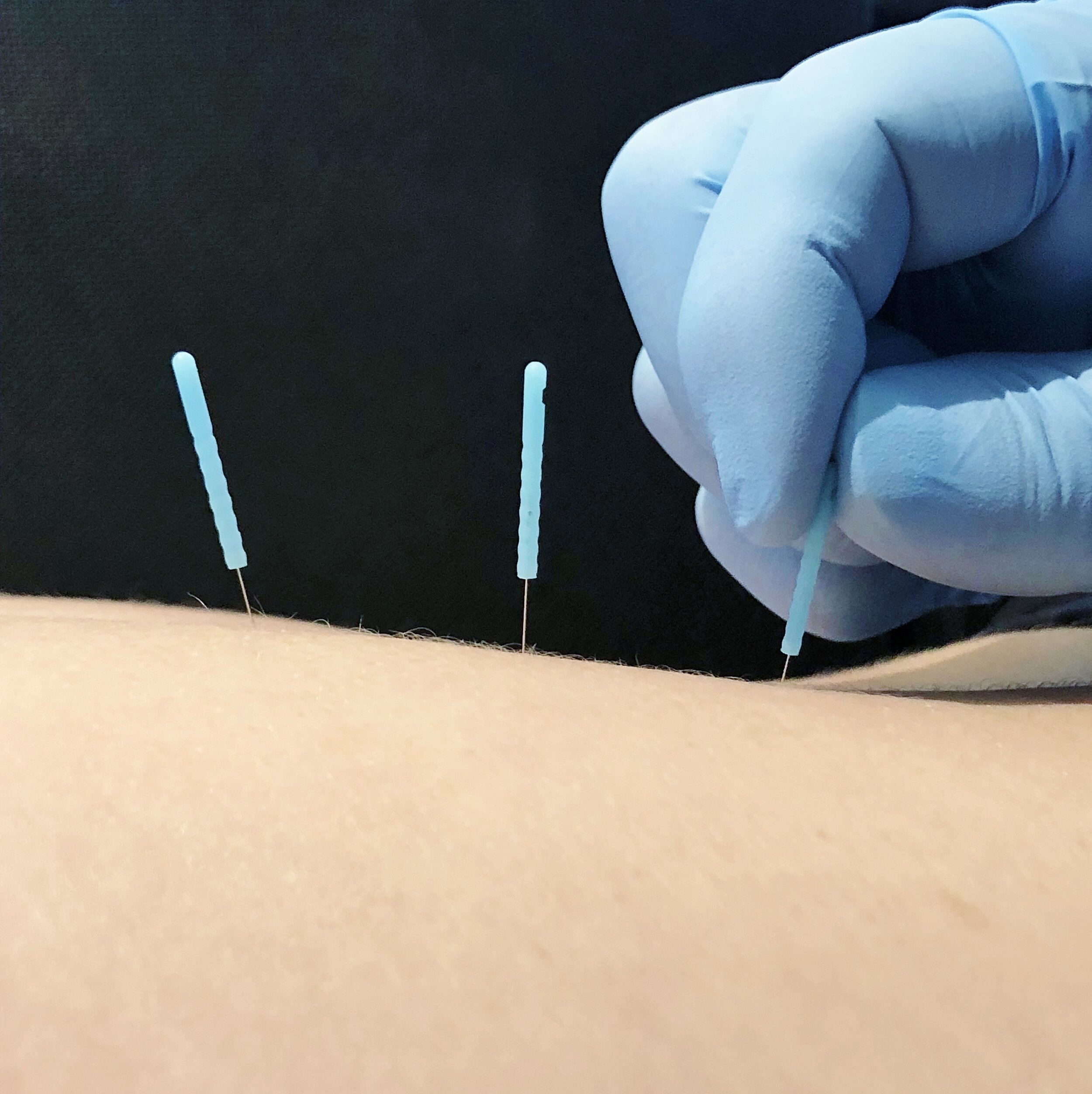 Dry Needling Halifax — Agricola Holistic Health